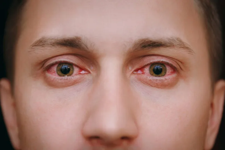 Air Pollution Emerging as Major Threat to Eye Health, Doctors Warn